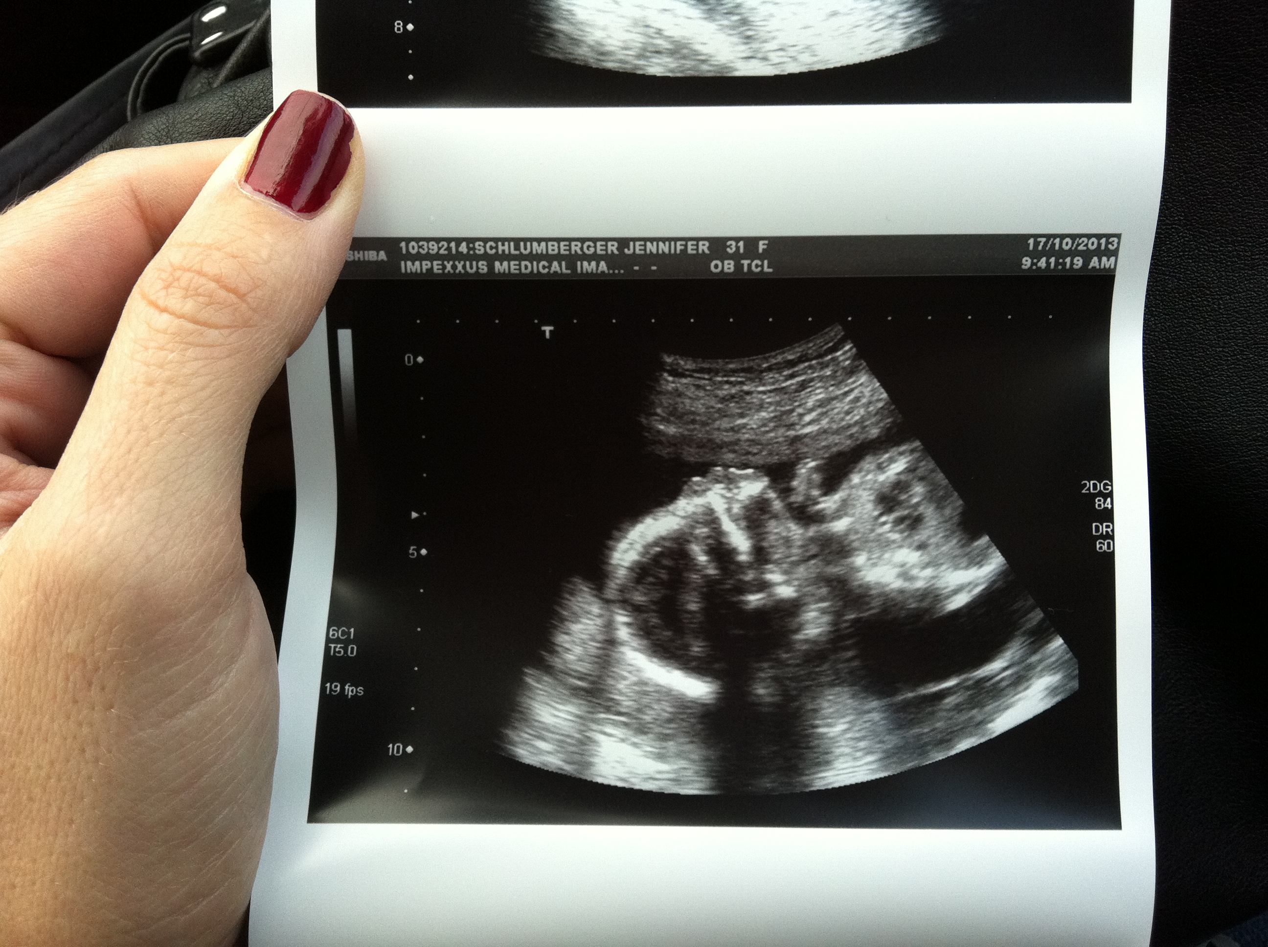 How is a nuchal scan done?