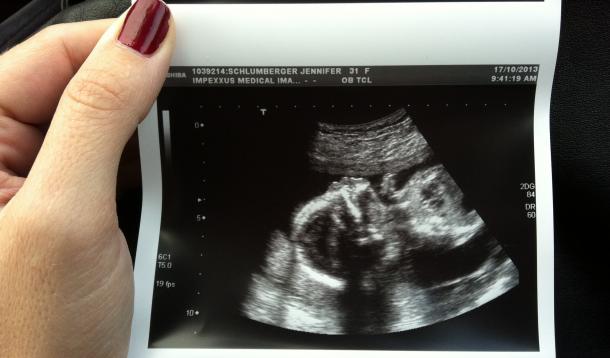 ultrasound, picture, 20 weeks, baby ultrasound, finding out gender, boy, girl, anatomy ultrasound