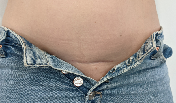 Women are sharing c-section scar selfies to challenge perceptions about  caesareans